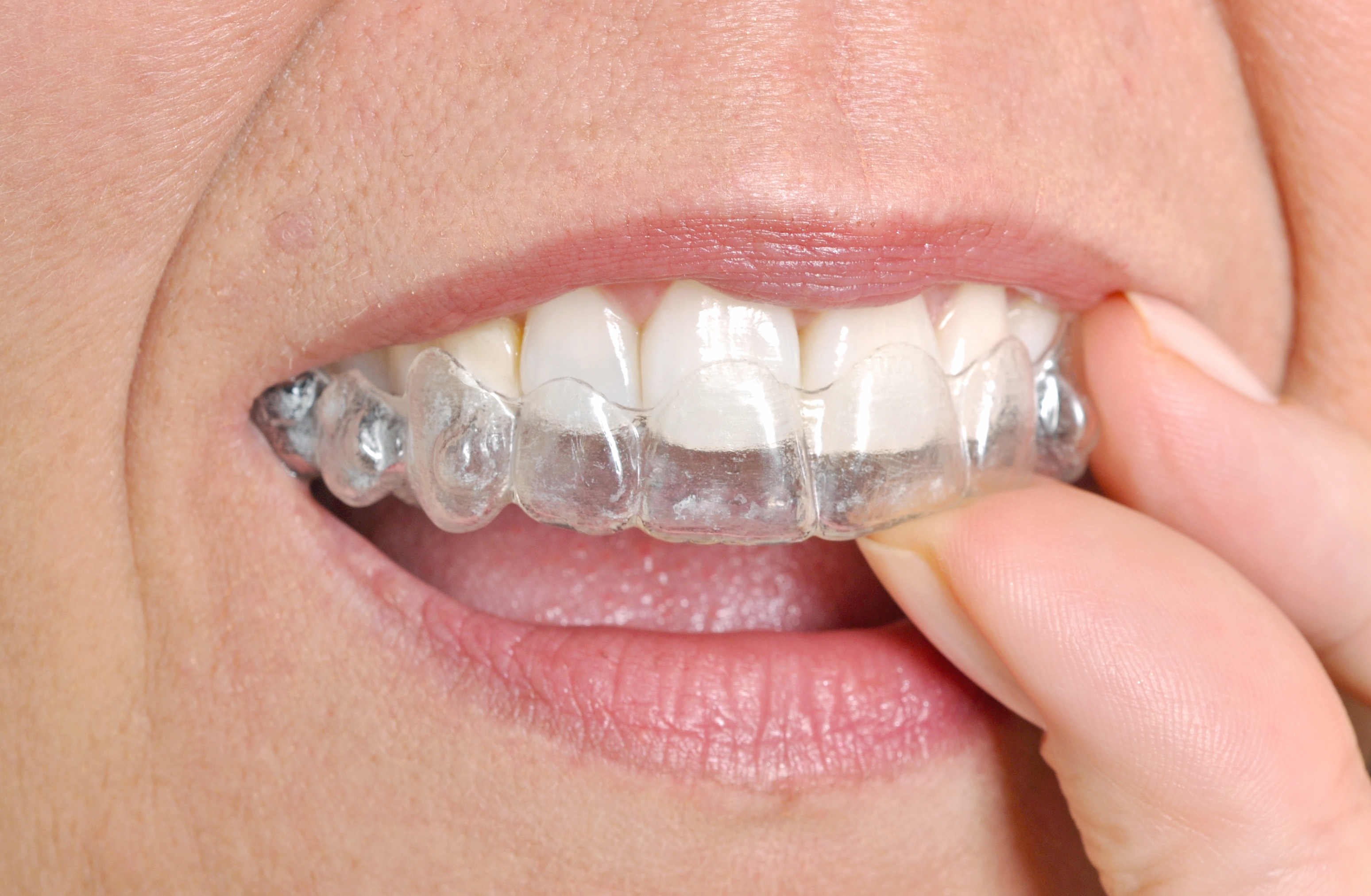 Is Invisalign Better than Braces?
